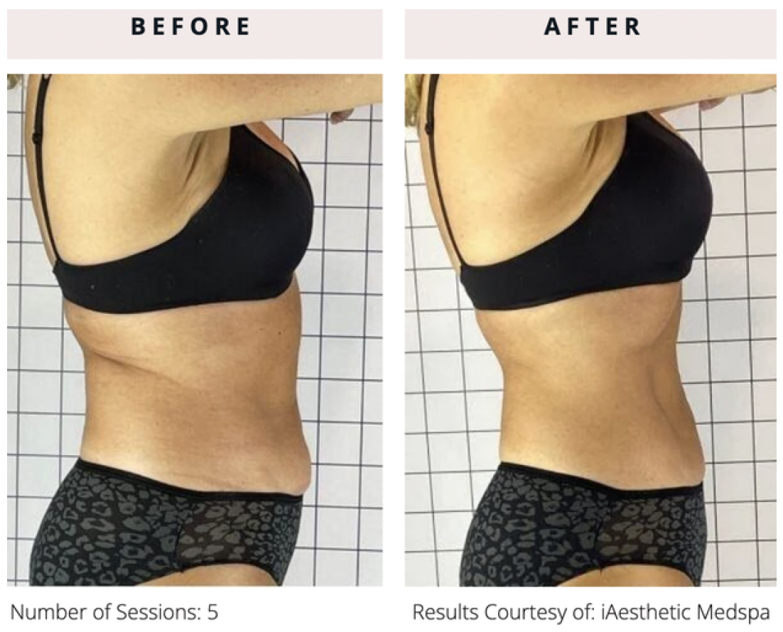 Practice Update: PHYSIQ Body Contouring